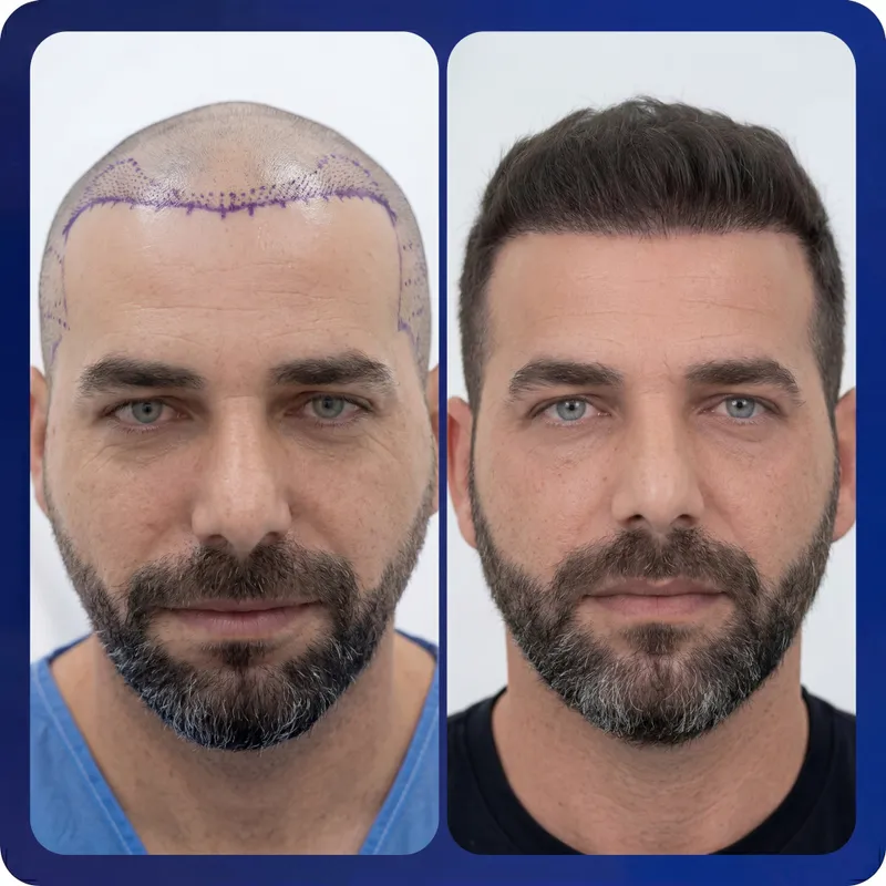 FUE hair transplant before and after - 4,800 grafts - maximum density