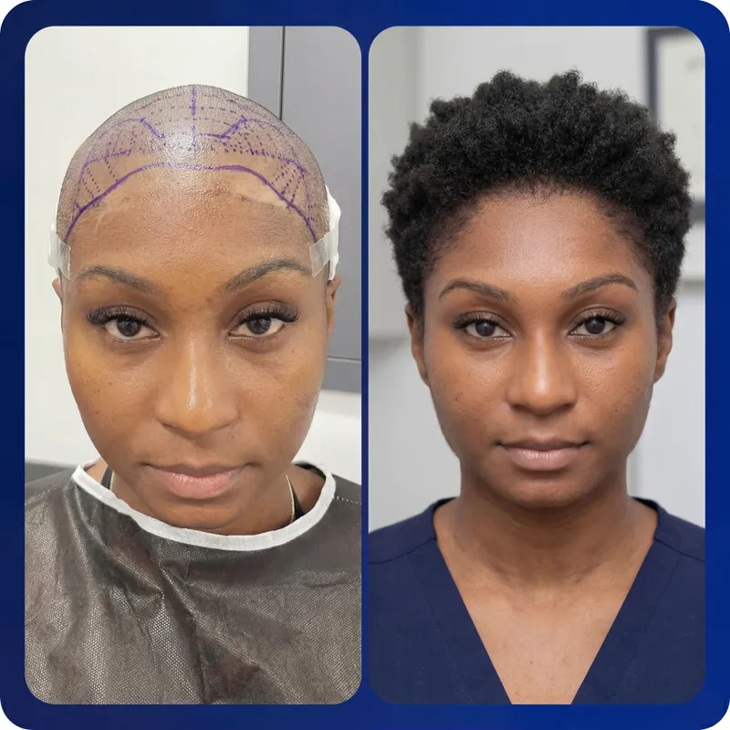 Hair transplant Turkey before and after result - 5,000 grafts - Norwood 5